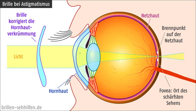 Eine Brille korrigiert Astigmatismus / Hornhautverkrümmung