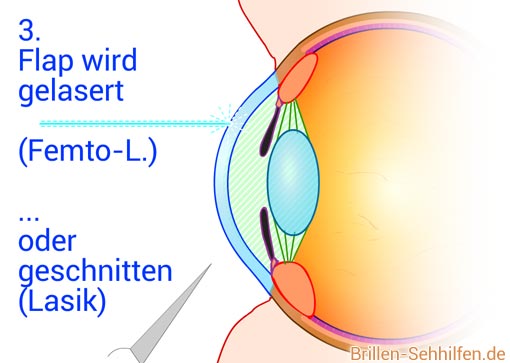 Augenkorrektur mit Laser