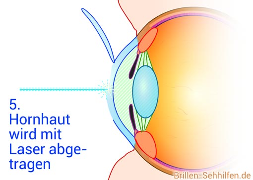 Augenlaser-Operation: Hornhaut wird mit Laser abgetragen