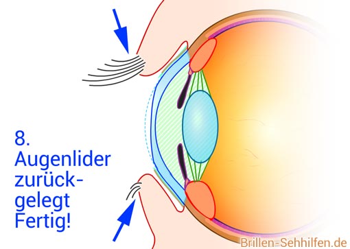Laserkorrektur: Augen wieder perfekt