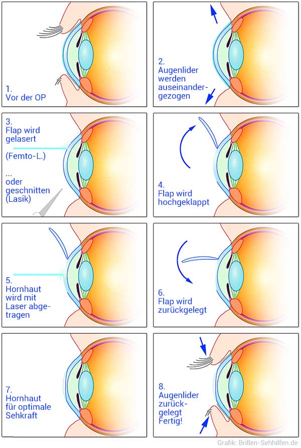 Augen-Operation mit Laser: Augenlasern
