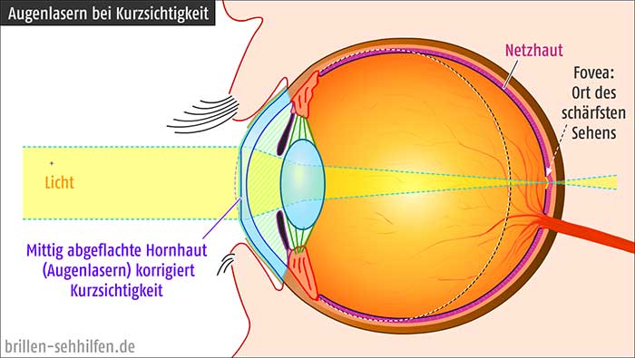 Augenlasern bei Kurzsichtigkeit
