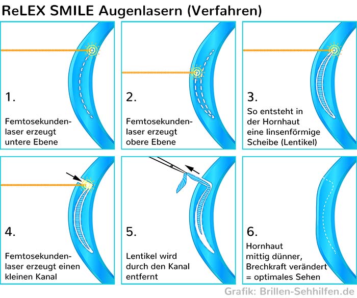 Augenlasern: ReLEX-Smile Verfahren