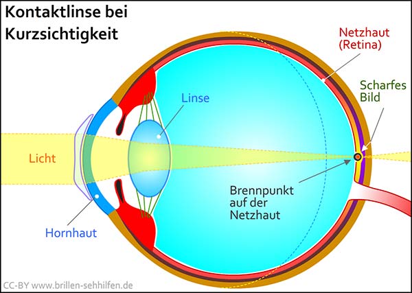Kontaktlinsen bei Kurzsichtigkeit